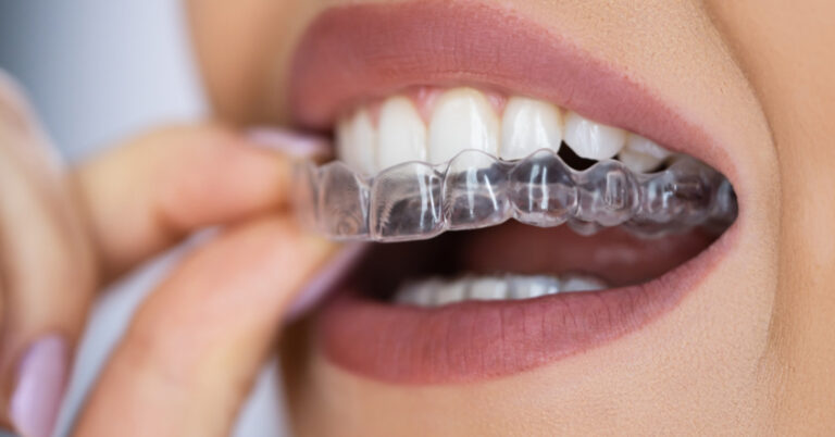 invisalign em pelotas