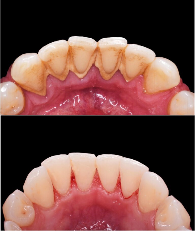 limpeza dental antes e depois